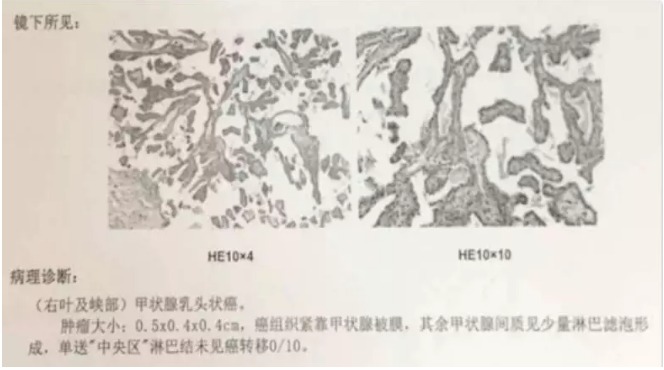 別慌，甲狀腺疾病還可以這樣投保！
